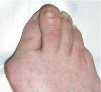 外反母趾の症例