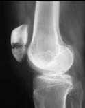 膝の怪我