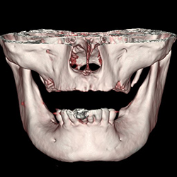 デジタルインプラント診断用CT撮影