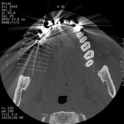 デジタルインプラント診断用CT撮影